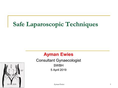 Principles of safe laparoscopic entry: a summary of the